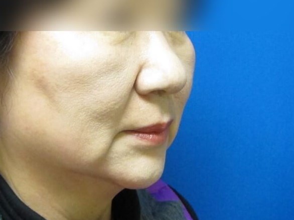 Face Lift Before