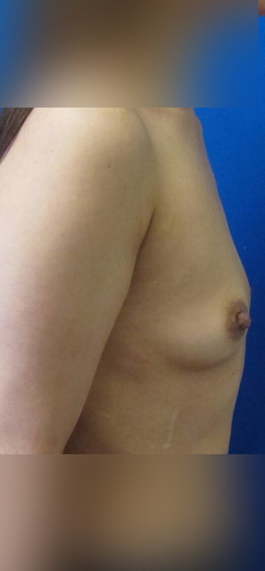 Breast Augmentation Before