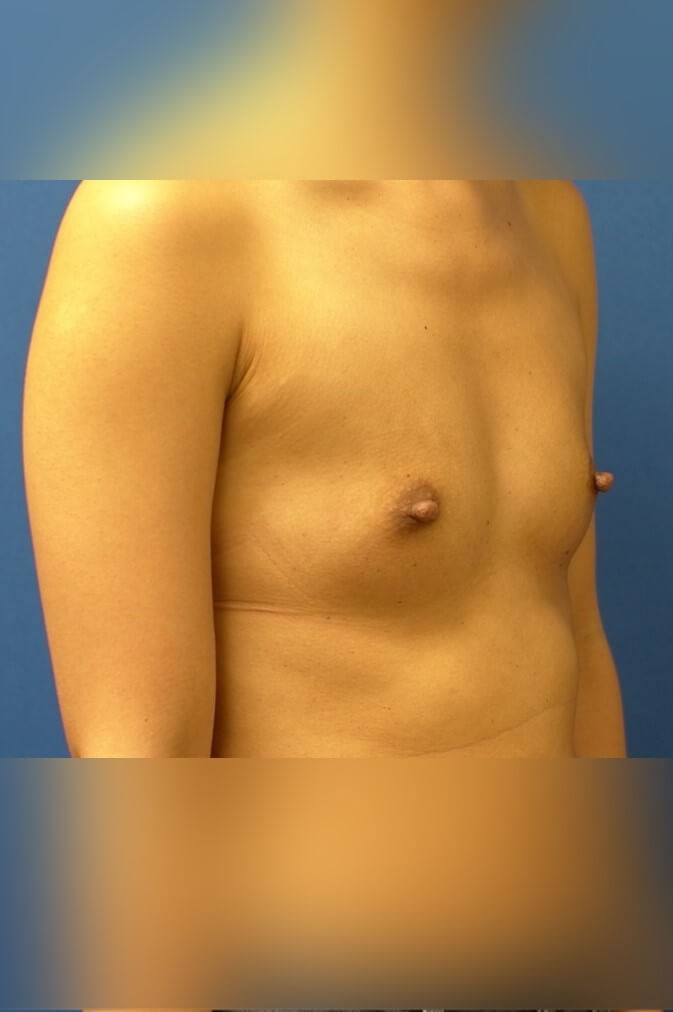 Breast Augmentation Before