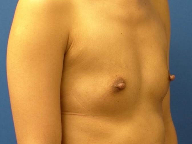 Breast Augmentation Before
