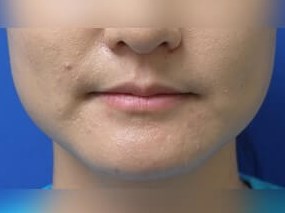 Botox Before
