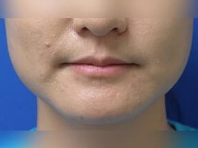 Juvederm Before
