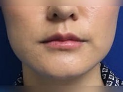 Juvederm After