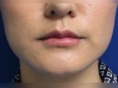 Botox After