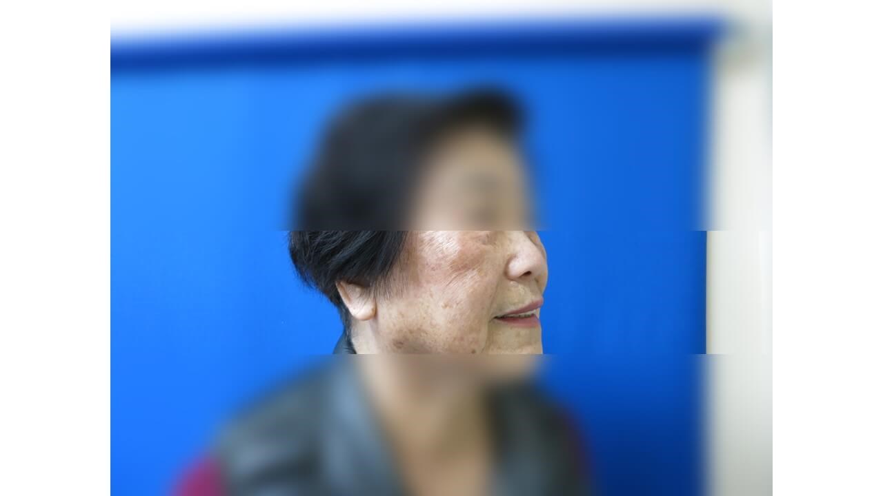 Laser Skin Toning  Before