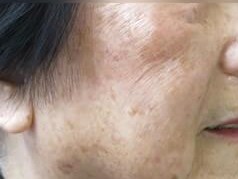 Laser Skin Toning  Before