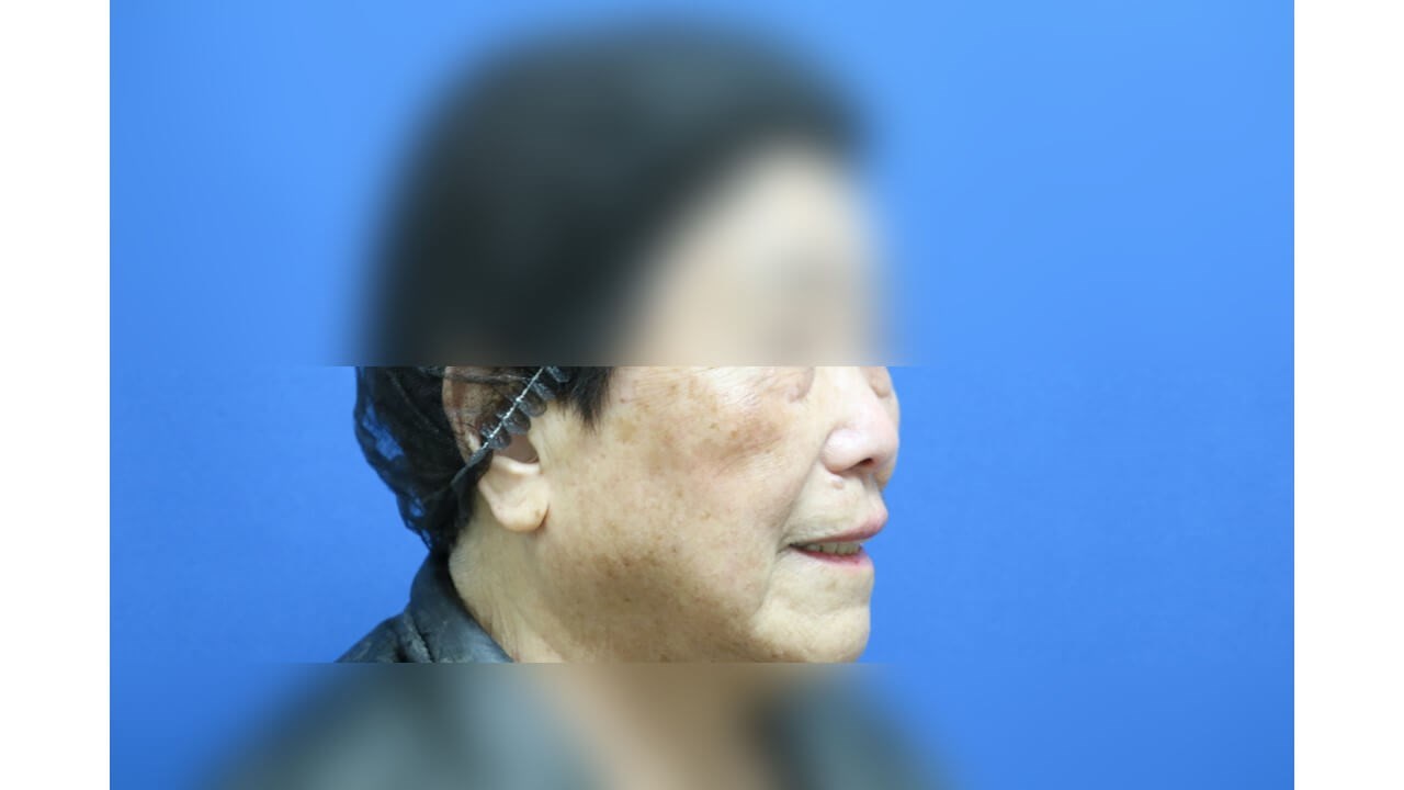 Laser Skin Toning  After