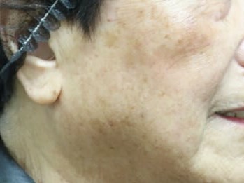 Laser Skin Toning  After