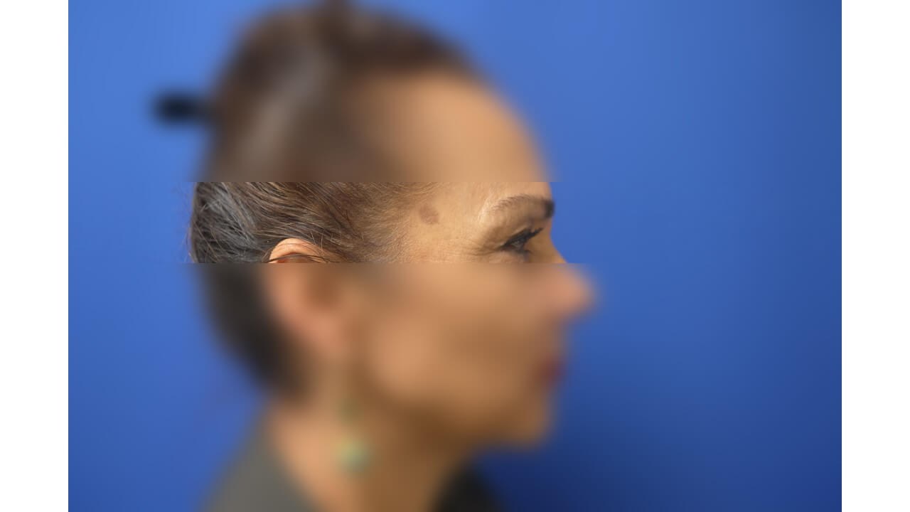 Laser Skin Toning Before