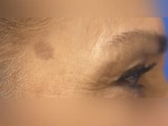 Laser Skin Toning Before