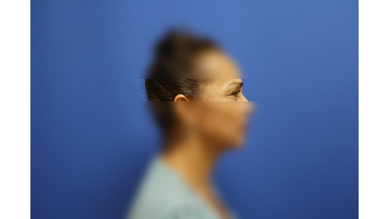 Laser Skin Toning After