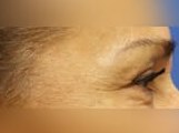 Laser Skin Toning After