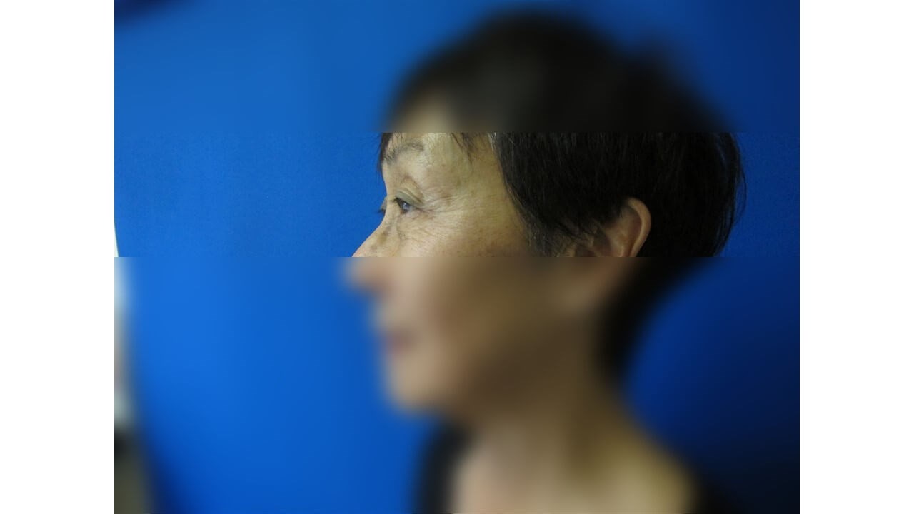 Laser Skin Toning Before