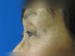 Laser Skin Toning Before