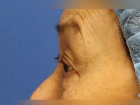 Laser Skin Toning After