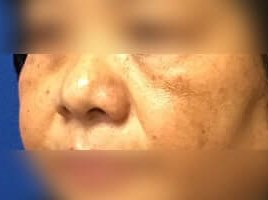 Laser Skin Toning Before