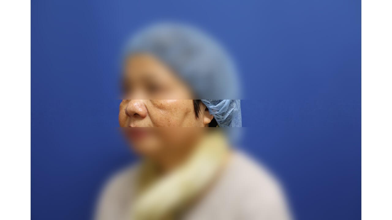 Laser Skin Toning After