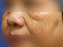 Laser Skin Toning After