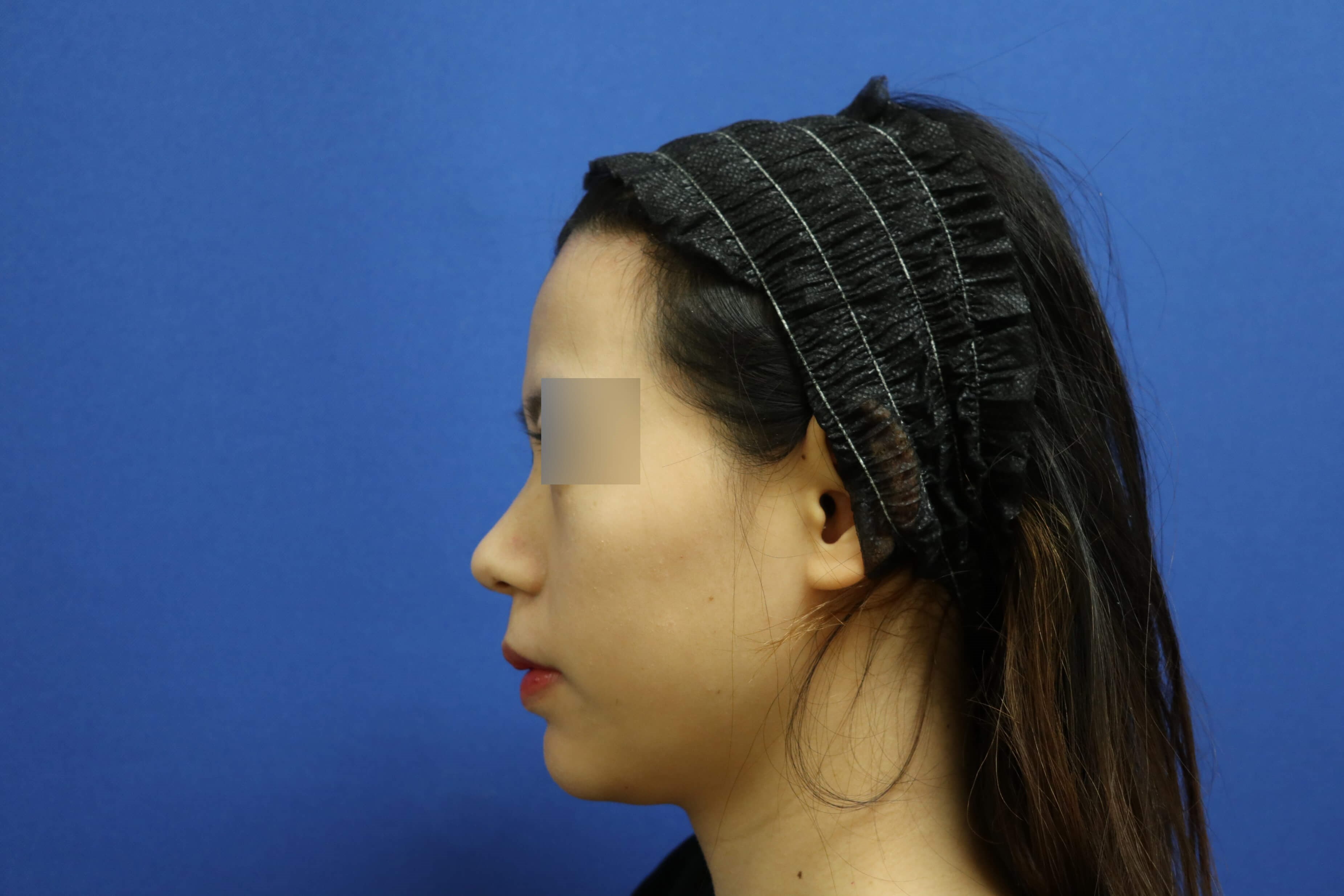 Rhinoplasty Before