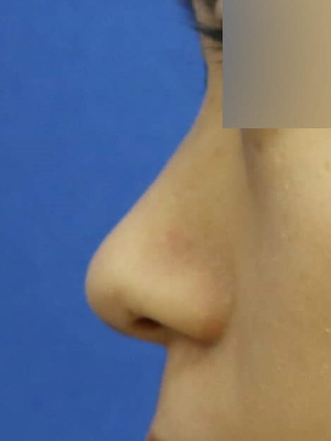 Rhinoplasty Before