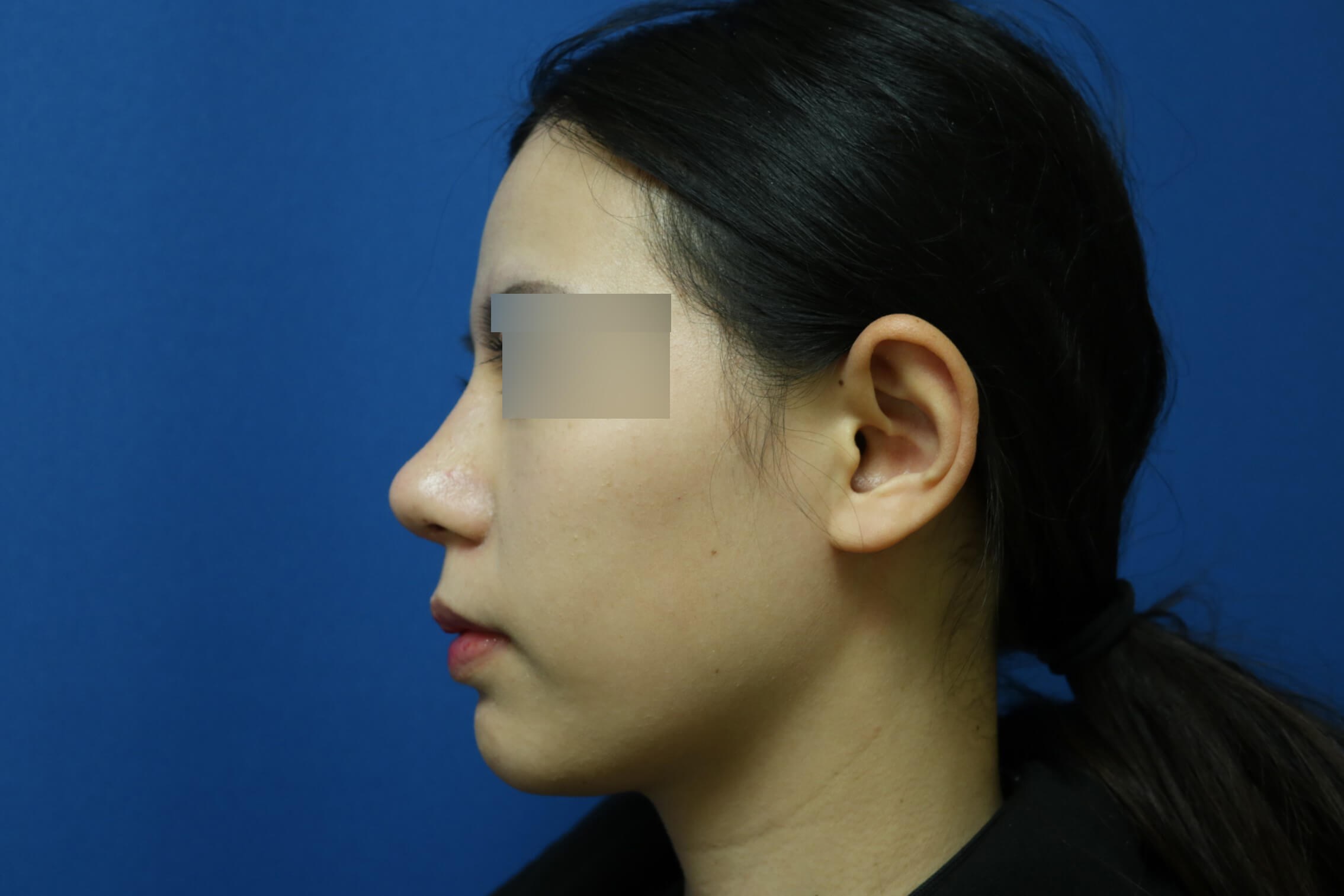 Rhinoplasty After