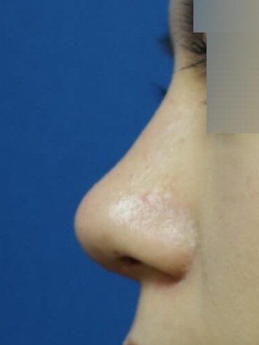 Rhinoplasty After