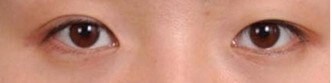 Asian Eyelid Surgery Before