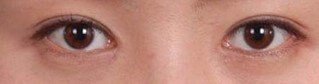 Asian Eyelid Surgery After