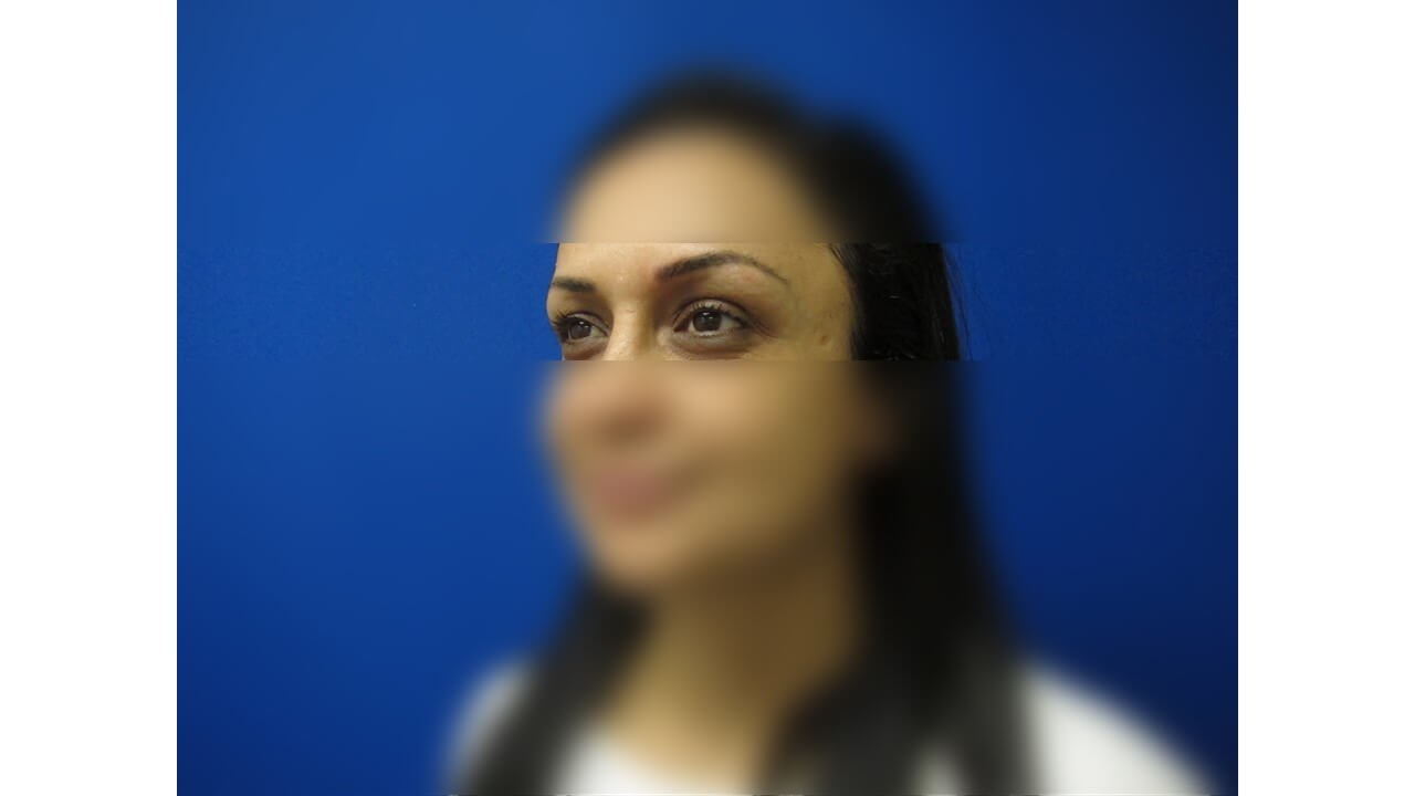 Laser Tattoo Removal Before