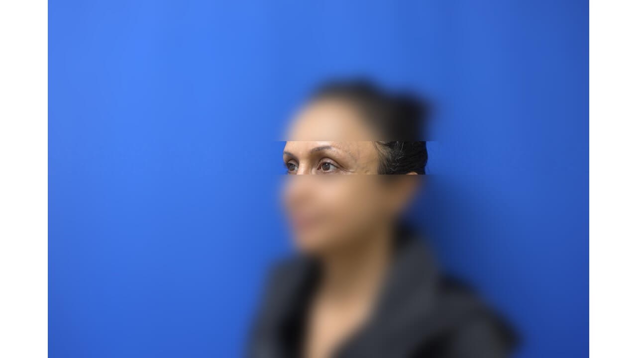 Laser Tattoo Removal After