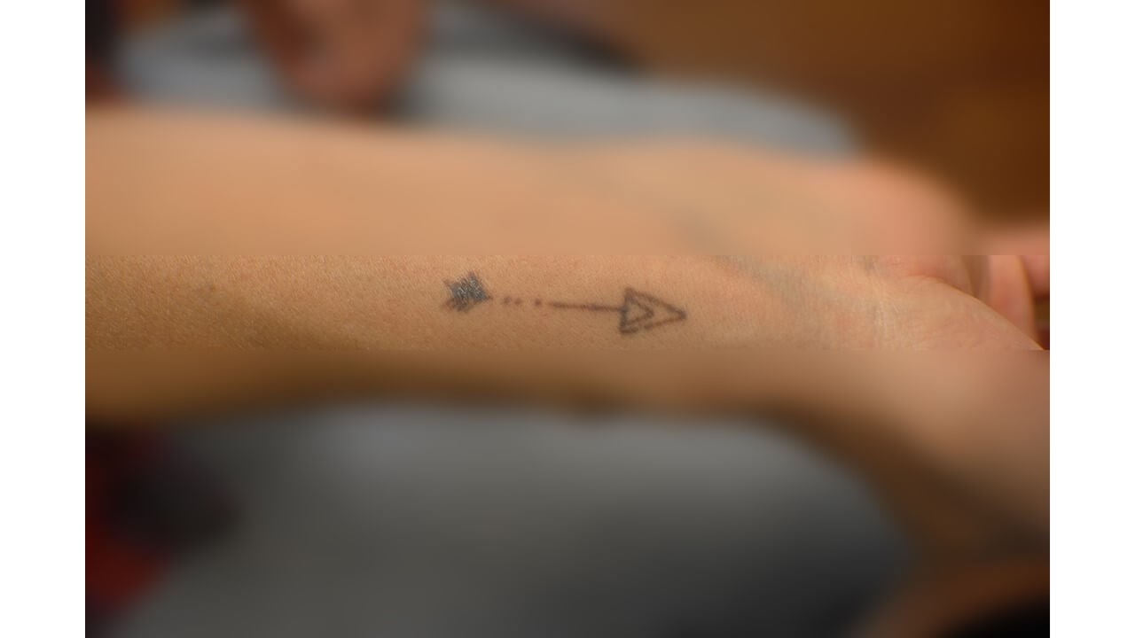Laser Tattoo Removal Before