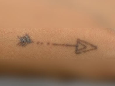 Laser Tattoo Removal Before