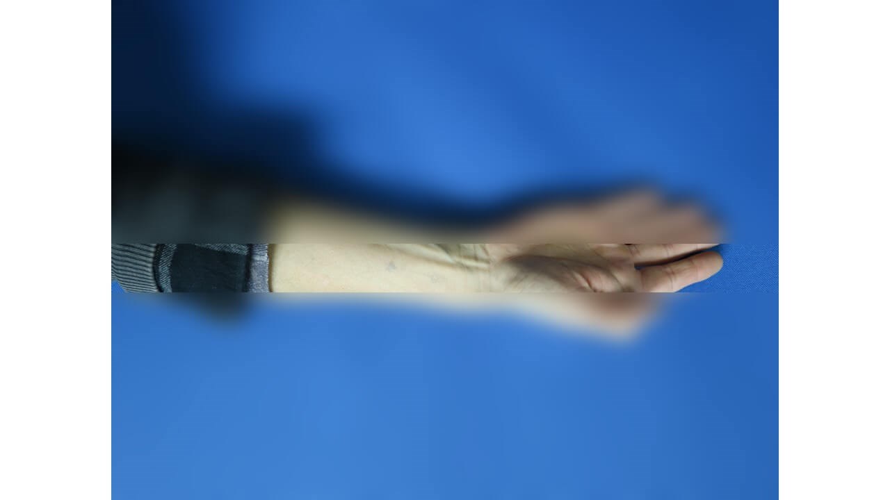 Laser Tattoo Removal After