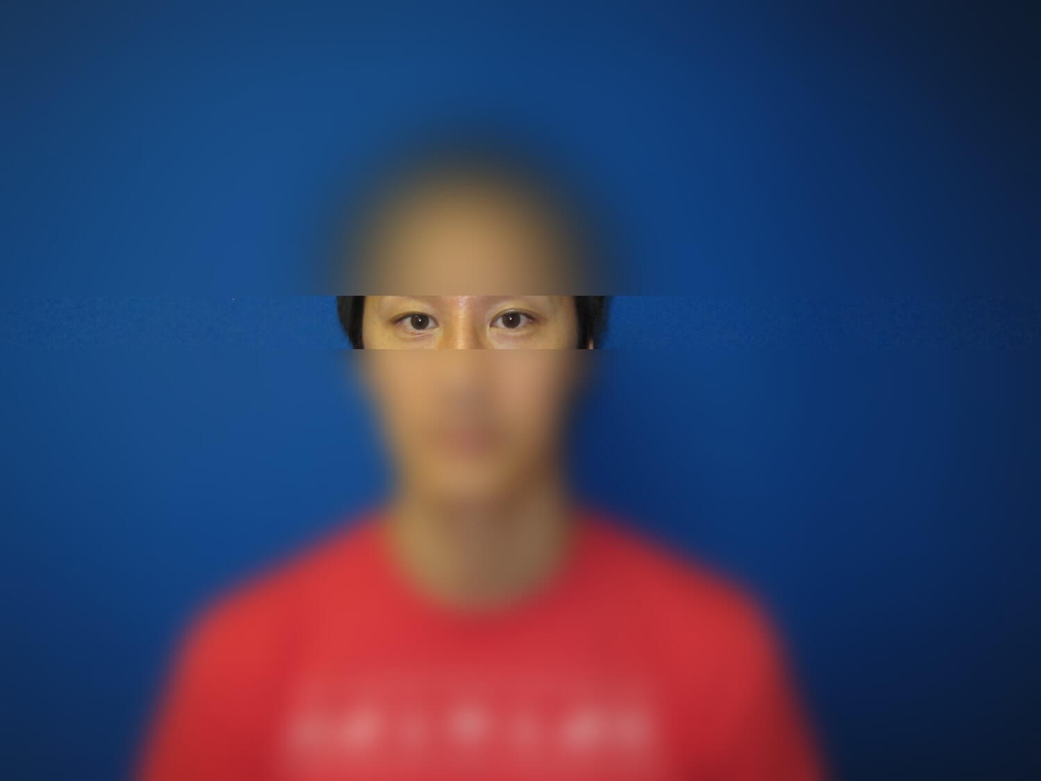 Asian Eyelid Before