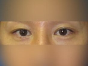 Asian Eyelid Before