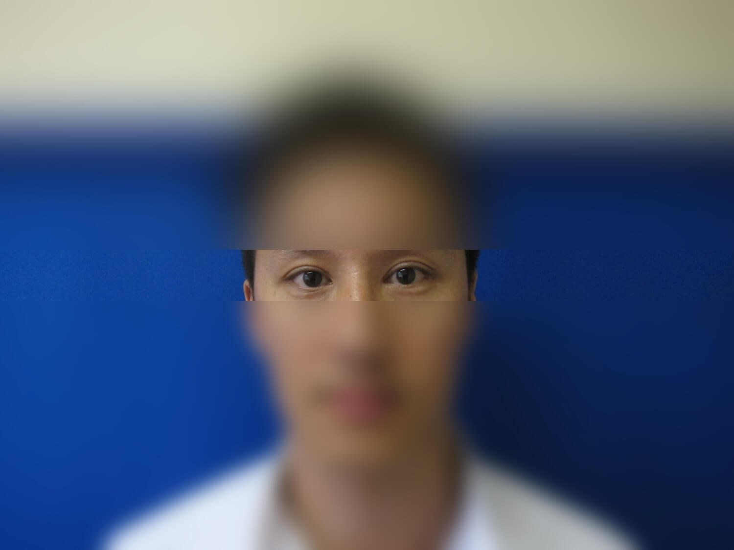 Asian Eyelid After