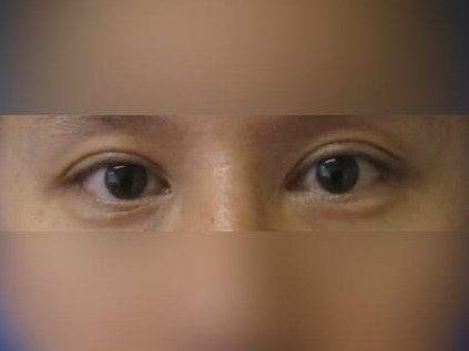 Asian Eyelid After