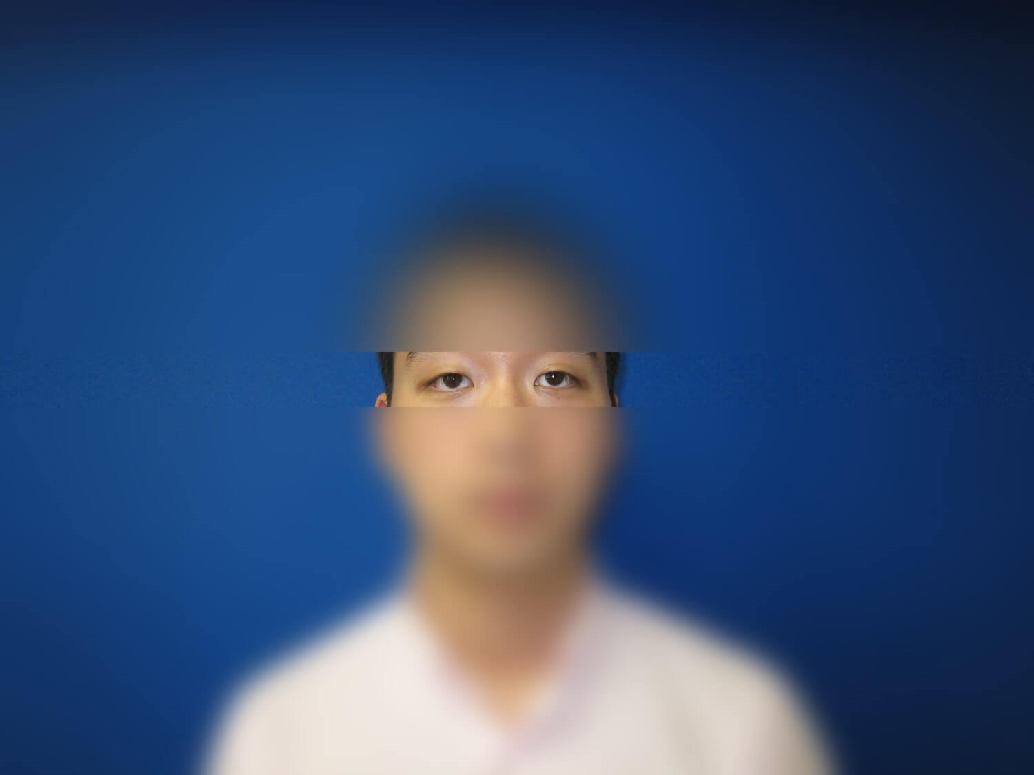Asian Eyelid Before