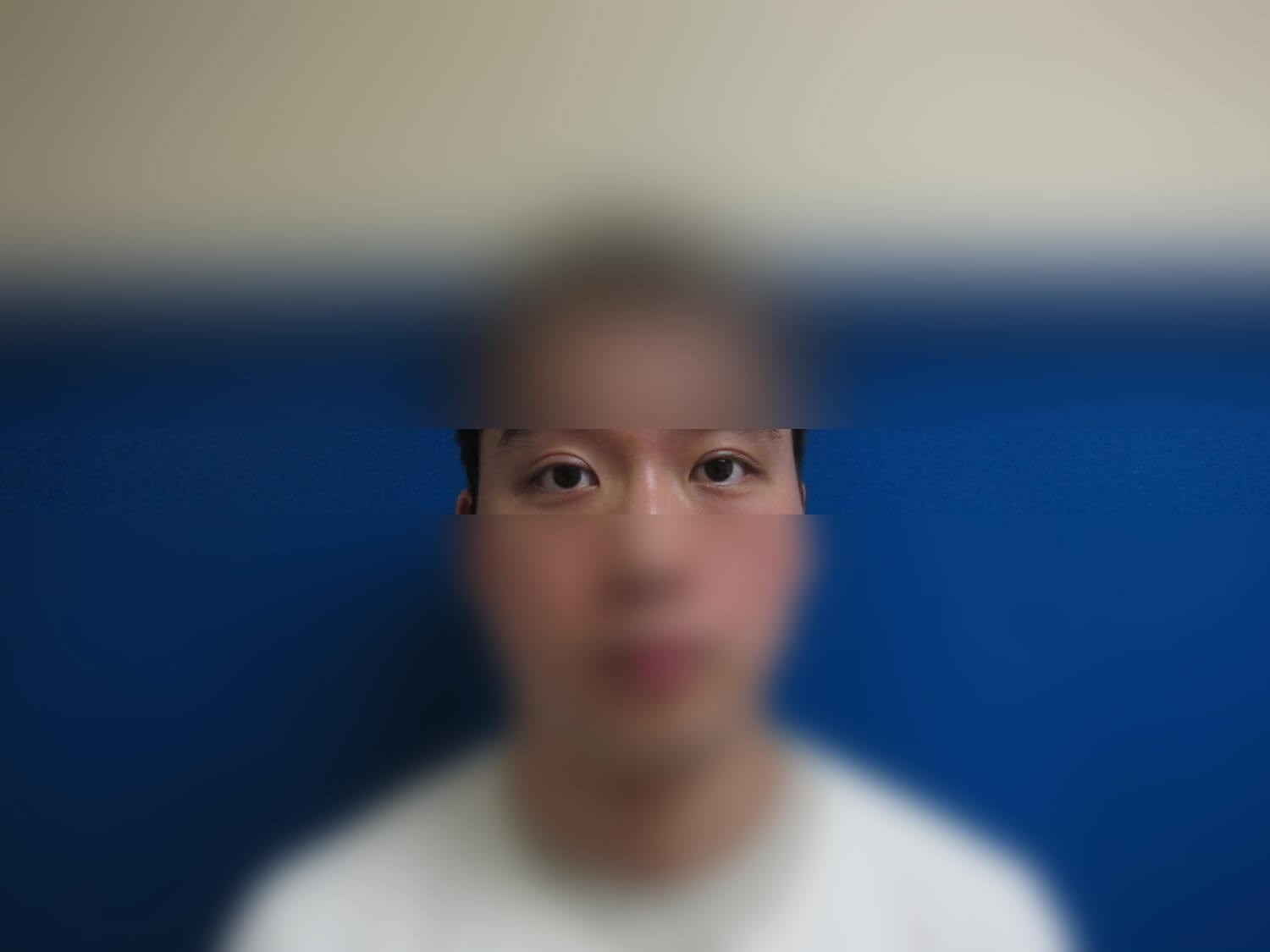 Asian Eyelid After