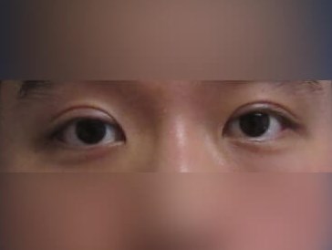 Asian Eyelid After