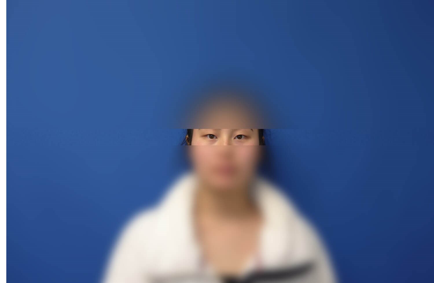 Asian Eyelid Before