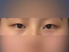 Asian Eyelid Before