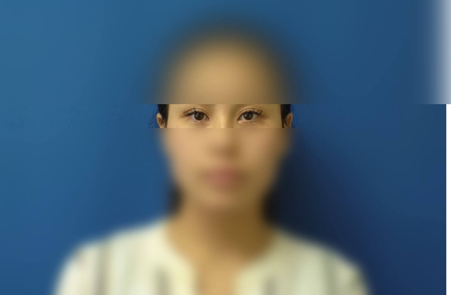 Asian Eyelid After