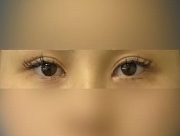 Asian Eyelid After