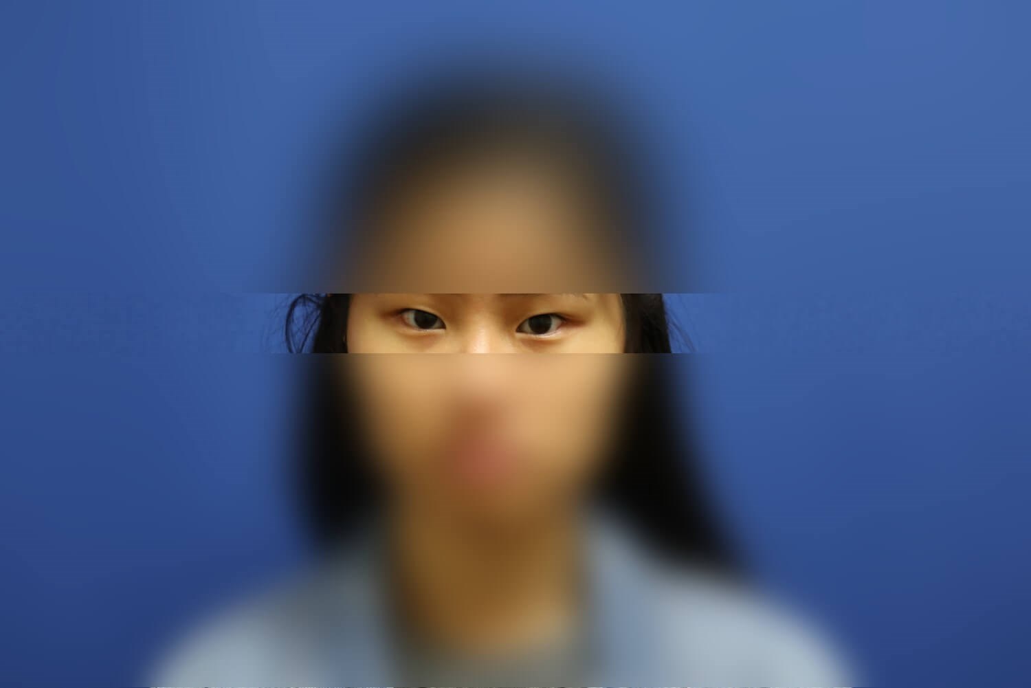 Asian Eyelid Before