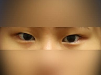 Asian Eyelid Before