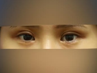 Asian Eyelid After