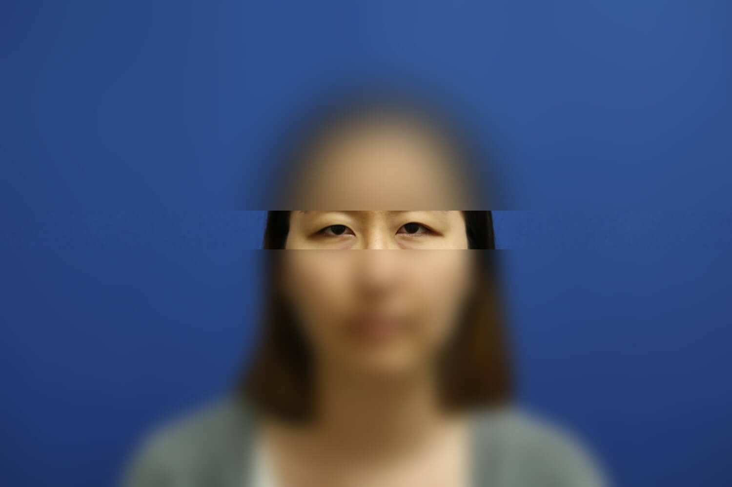 Asian Eyelid Before