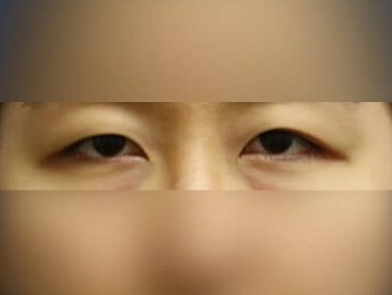 Asian Eyelid Before
