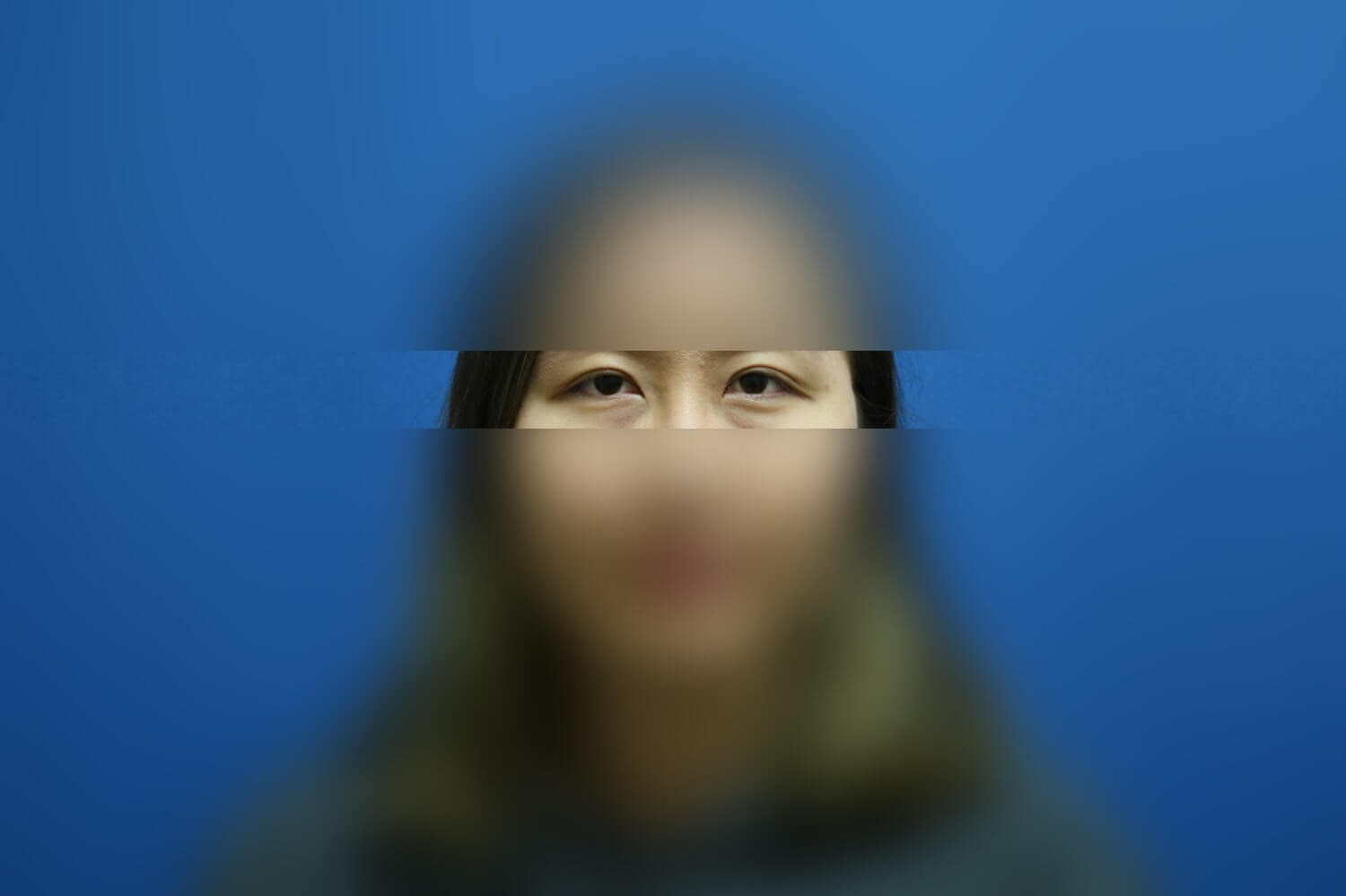 Asian Eyelid After